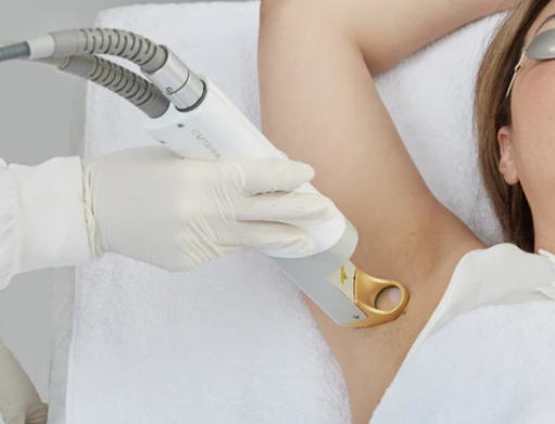 woman getting laser hair removal on her underarms