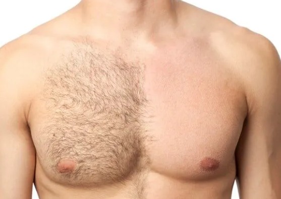 before and after of laser hair removal on a man