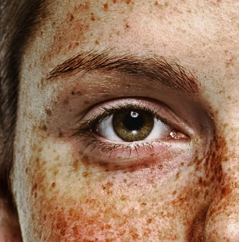 sun damage on a woman's face